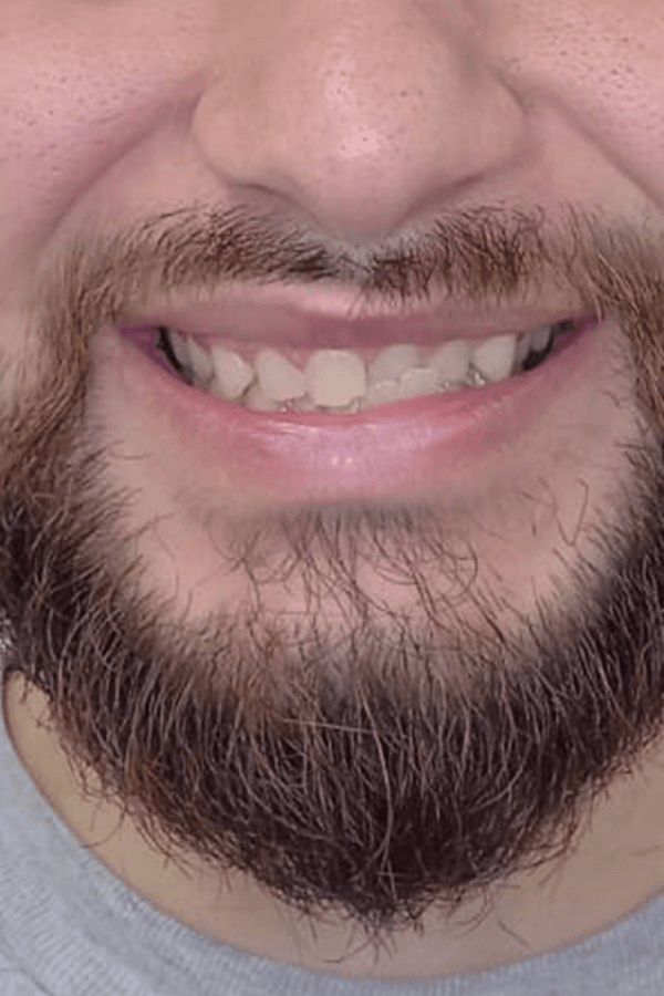 Bite Issues